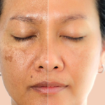 How to Reverse Sun Damage and Restore Your Skin’s Glow